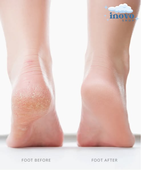 PediCare™ Flawless Electronic File Tool & Callus Remover ✨